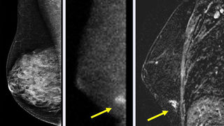 Прегледите на рак на гърдата носят риск от преувеличена <span class="highlight">диагноза</span>
