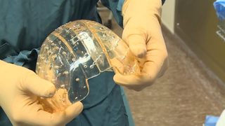 Лекари имплантираха на жена череп, създаден на 3D <span class="highlight">принтер</span> (видео)
